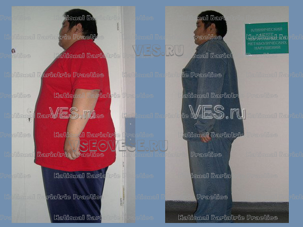 Снижение Веса После Шунтирования Желудка