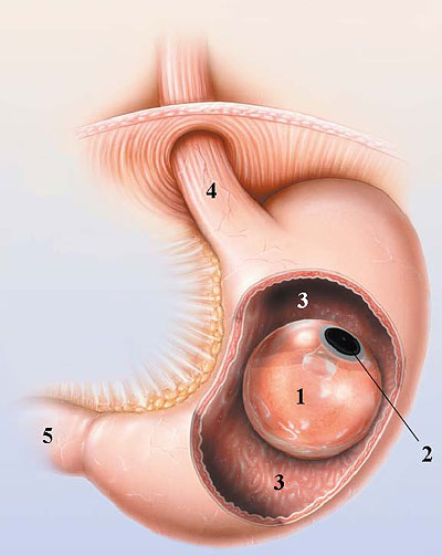 BIB  - Bioenterics Intragastric Balloon -    Bioenterics