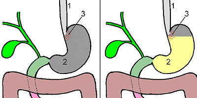 УМЕНЬШЕНИЕ ЖЕЛУДКА - Рецепторы насыщения в желудке. Слева показан пустой желудок, справа желудок, заполненный пищей желтого цвета. 