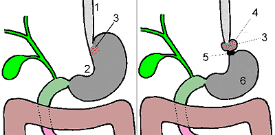 УМЕНЬШЕНИЕ ЖЕЛУДКА - Принцип действия ограничительного кольца на желудке. Слева – исходная схема, справа – вид после операции. 