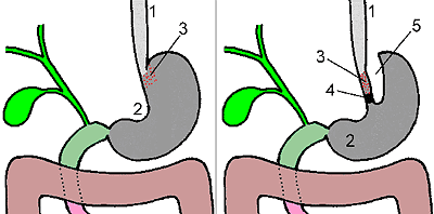 УМЕНЬШЕНИЕ ЖЕЛУДКА - Схема вертикальной гастропластики. Слева – исходная схема, справа – вид после операции.