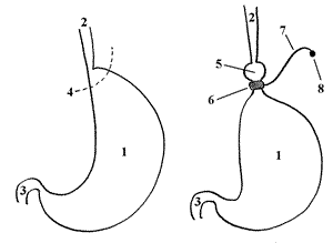 БАНДАЖИРОВАНИЕ ЖЕЛУДКА - Схема операции (слева до операции; справа после операции) 1 – желудок, 2 – пищевод, 3 - двенадцатиперстная кишка, 4 - линия установки кольца на желудке, 5 - малый желудочек над кольцом , 6 – кольцо, 7 - соединительная трубочка, 8 – порт. 